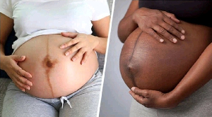Reasons why a tiny dark line appears on pregnant women’s belly